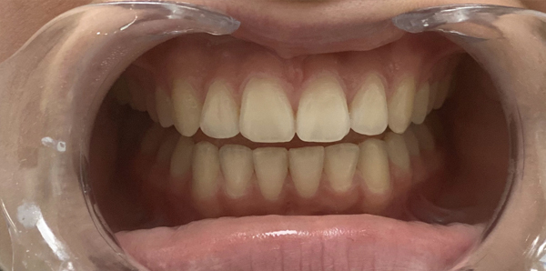 Teeth Whitening Waterdown