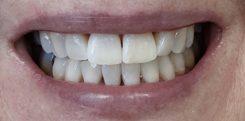 Teeth Whitening 15