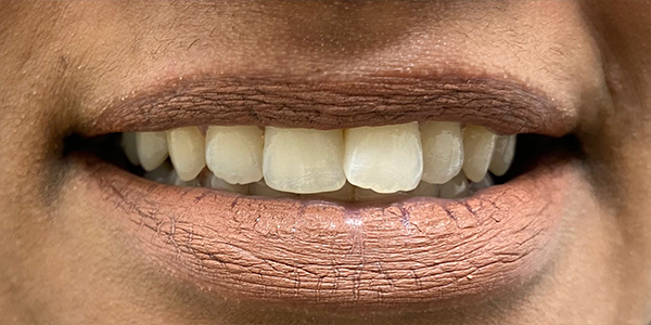 teeth before and after - blossom smiles dental