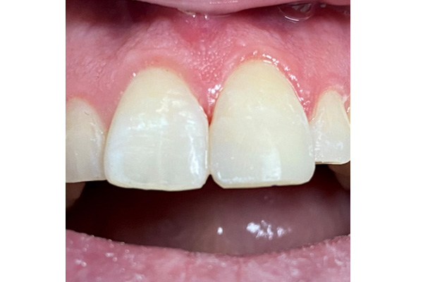 before and after - blossom smiles dental