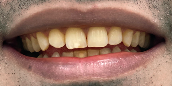 teeth before and after - blossom smiles dental